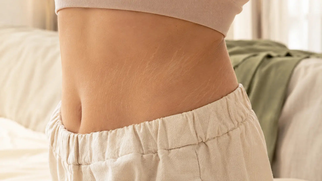 Natural stretch marks on body skin in soft daylight for a CABAID guide to realistic stretch mark cream results